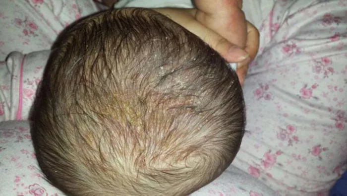 Cách trị cứt trâu ở trẻ sơ sinh (viêm da tiết bã) đơn giản - MarryBaby Cách trị cứt trâu ở trẻ sơ sinh (viêm da tiết bã) đơn giản - MarryBaby