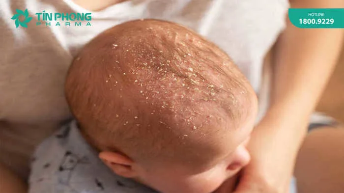 3 cách trị cứt trâu cho trẻ sơ sinh được chuyên gia tin tưởng nhất 3 cách trị cứt trâu cho trẻ sơ sinh được chuyên gia tin tưởng nhất