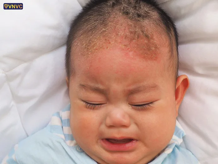 Viêm da tiết bã: nguyên nhân, triệu chứng, điều trị và cách phòng ngừa - Công ty Cổ phần Vacxin Việt Nam Viêm da tiết bã: nguyên nhân, triệu chứng, điều trị và cách phòng ngừa - Công ty Cổ phần Vacxin Việt Nam