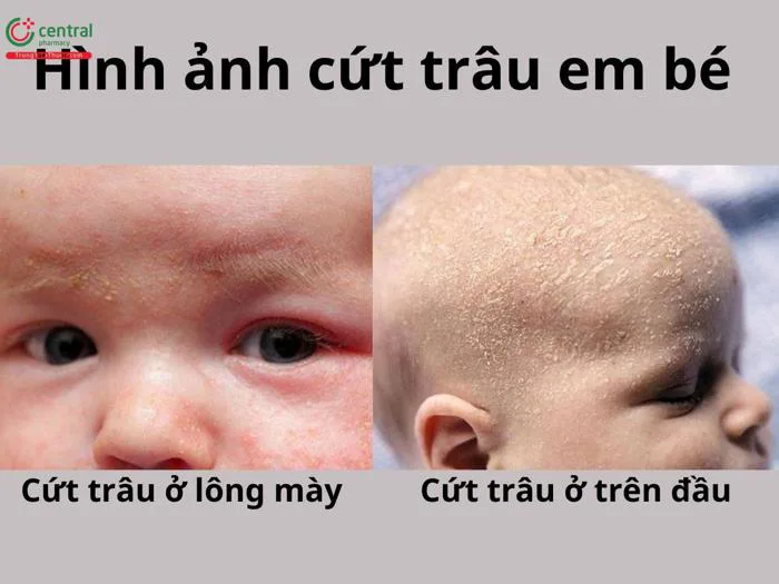 Cứt trâu (viêm da tiết bã) em bé là gì? Cách trị cứt trâu cho trẻ sơ sinh Cứt trâu (viêm da tiết bã) em bé là gì? Cách trị cứt trâu cho trẻ sơ sinh