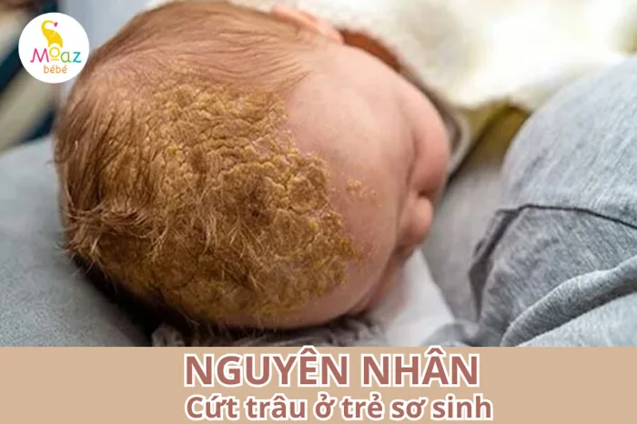 Cứt trâu ở trẻ sơ sinh là gì? Những mẹo trị cứt trâu hiệu quả Cứt trâu ở trẻ sơ sinh là gì? Những mẹo trị cứt trâu hiệu quả