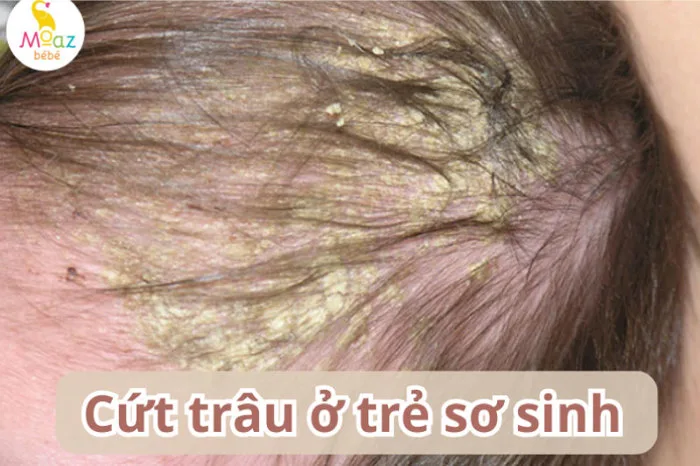 Cứt trâu ở trẻ sơ sinh là gì? Những mẹo trị cứt trâu hiệu quả Cứt trâu ở trẻ sơ sinh là gì? Những mẹo trị cứt trâu hiệu quả