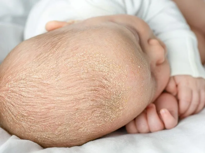Bật mí những mẹo trị cứt trâu ở trẻ sơ sinh hiệu quả - Nhà thuốc FPT Long Châu Bật mí những mẹo trị cứt trâu ở trẻ sơ sinh hiệu quả - Nhà thuốc FPT Long Châu