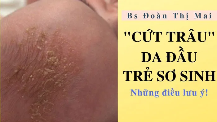 Cứt Trâu da đầu trẻ sơ sinh: Xử lý thế nào? | Bác Sĩ Đoàn Thị Mai Cứt Trâu da đầu trẻ sơ sinh: Xử lý thế nào? | Bác Sĩ Đoàn Thị Mai