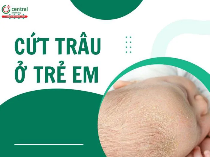 Cứt trâu (viêm da tiết bã) em bé là gì? Cách trị cứt trâu cho trẻ sơ sinh Cứt trâu (viêm da tiết bã) em bé là gì? Cách trị cứt trâu cho trẻ sơ sinh