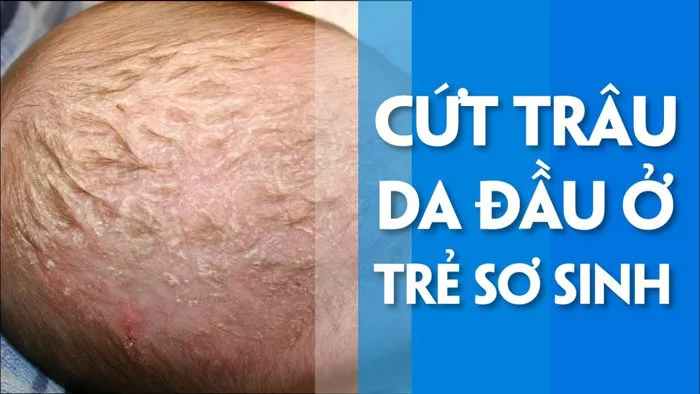 Cứt trâu trên đầu trẻ: Nguyên nhân và cách trị dứt điểm Cứt trâu trên đầu trẻ: Nguyên nhân và cách trị dứt điểm