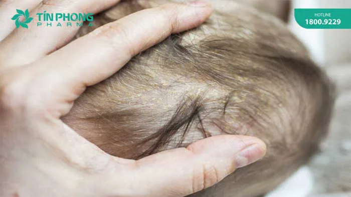 3 cách trị cứt trâu cho trẻ sơ sinh được chuyên gia tin tưởng nhất 3 cách trị cứt trâu cho trẻ sơ sinh được chuyên gia tin tưởng nhất