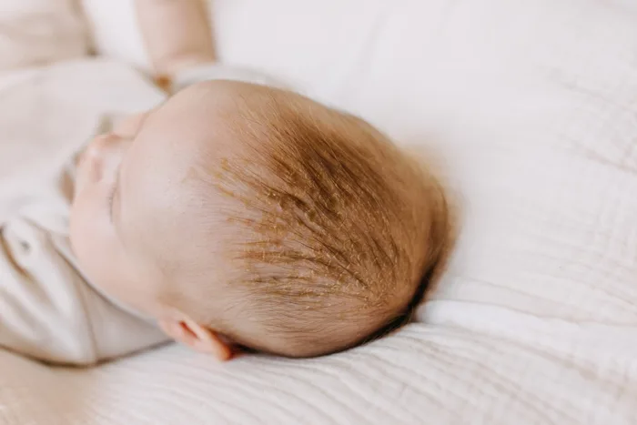 Cách trị cứt trâu ở trẻ sơ sinh (viêm da tiết bã) đơn giản - MarryBaby Cách trị cứt trâu ở trẻ sơ sinh (viêm da tiết bã) đơn giản - MarryBaby