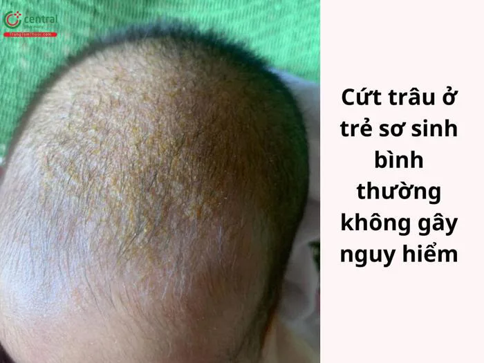 Cứt trâu (viêm da tiết bã) em bé là gì? Cách trị cứt trâu cho trẻ sơ sinh Cứt trâu (viêm da tiết bã) em bé là gì? Cách trị cứt trâu cho trẻ sơ sinh