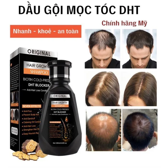 Dầu Gội Mọc Tóc Dầu Gội Chống Rụng Tóc Dầu Gội Giảm Gàu250ml Giảm Gàu,Nấm  Ngứa, Kích Thích Mọc Tóc, Giảm rụng tóc, Bảo Vê Nang Tóc Chắc Khỏe, Suôn ...