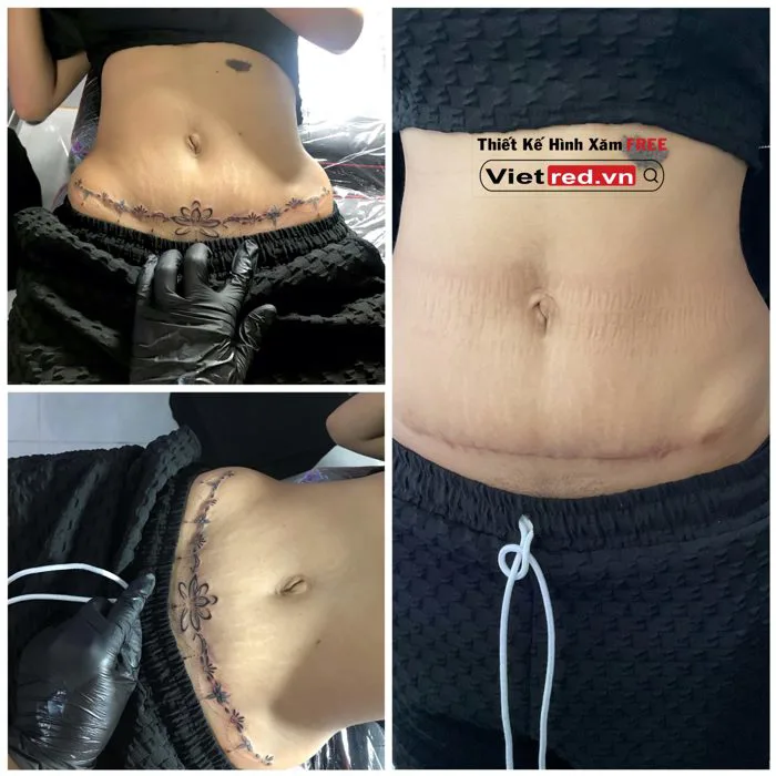 Sự tự tin trở lại với hình xăm che sẹo ở bụng cho em gái