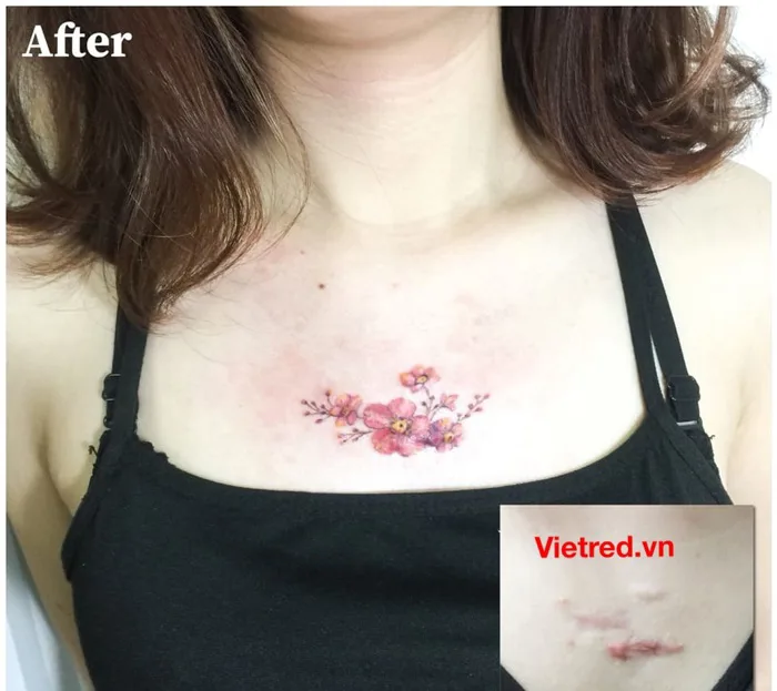 Hình xăm che sẹo ở ngực – Che sẹo do mổ treo ngực sa trể