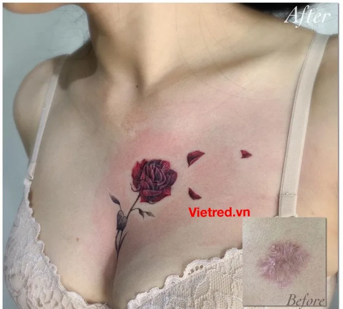Hình xăm che sẹo ở ngực – Che sẹo do mổ treo ngực sa trể