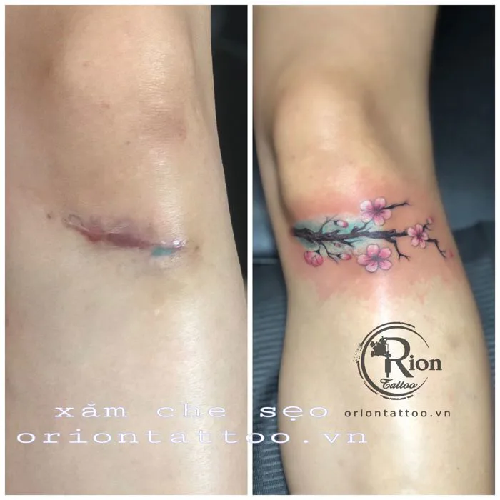 Top 3 Địa Chỉ Xóa Xăm Không Sẹo Uy Tín Nhất Quận Bình Thạnh - Xóa hình xăm  bằng laser mất bao...