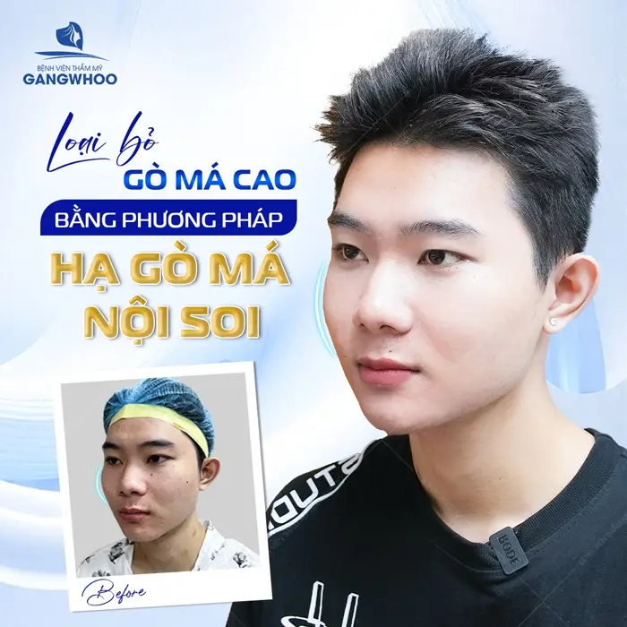 Hạ Gò Má Cho Nam Giới Có Cần Thiết Không? Nên Lưu Ý Những Gì Hạ Gò Má Cho Nam Giới Có Cần Thiết Không? Nên Lưu Ý Những Gì