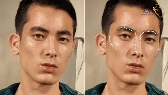 Gò má cao như thế nào? Có gây sát chồng không? - Bệnh viện thẩm mỹ Á Âu Gò má cao như thế nào? Có gây sát chồng không? - Bệnh viện thẩm mỹ Á Âu