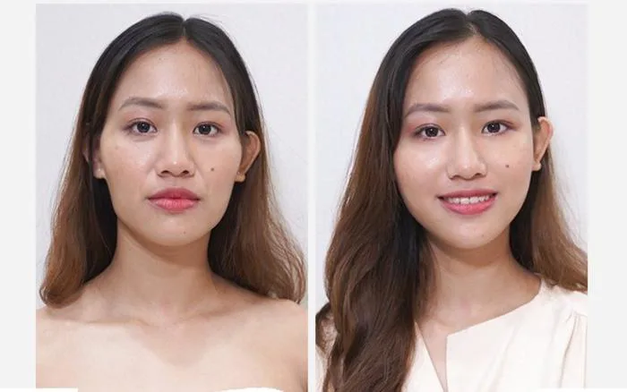 Gò Má Cao Là Như Thế Nào? Gò Má Cao Là Tốt Hay Xấu? - VITA Clinic Gò Má Cao Là Như Thế Nào? Gò Má Cao Là Tốt Hay Xấu? - VITA Clinic