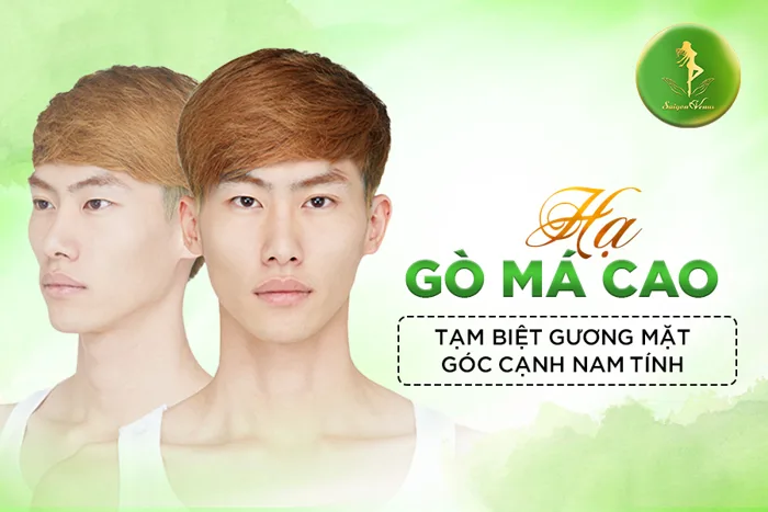 Hạ gò má cao - Tạm biệt gương mặt góc cạnh nam tính - Sài Gòn Venus Hạ gò má cao - Tạm biệt gương mặt góc cạnh nam tính - Sài Gòn Venus
