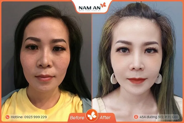 Phẫu Thuật Hạ Gò Má Cao Thanh Tú Tại BVTM Nam An Phẫu Thuật Hạ Gò Má Cao Thanh Tú Tại BVTM Nam An